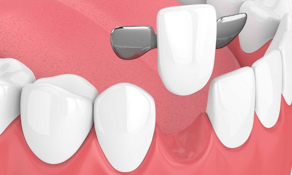 Maryland Köprü Diş