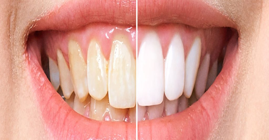 Zirkonyum Kaplama Nasıl Yapılır